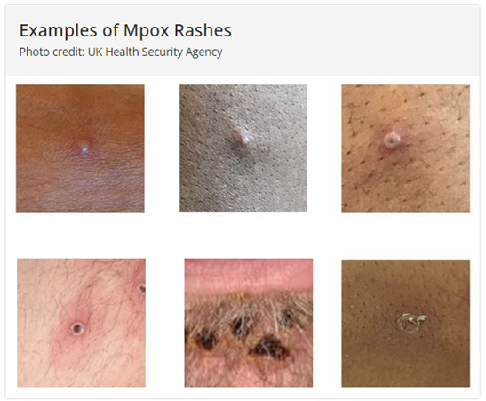 Examples of Mpox Rashes