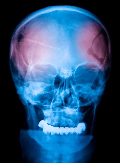 craniofacial_distractors[1]