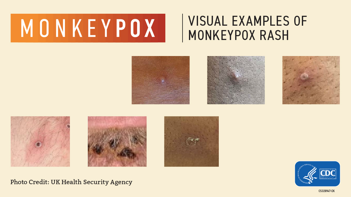 Monkeypox-Visuals-1200x675-02
